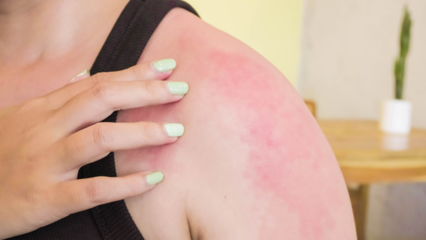 Ways to Reduce Inflammation